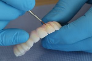 Prothèse dentaire céramique et esthétique