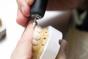 Prothèses dentaires conjointes
