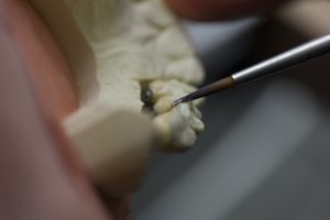 Prothèse dentaire implantaire